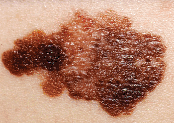 Image: a melanoma on a patient’s skin (Photo courtesy of the US National Cancer Institute).